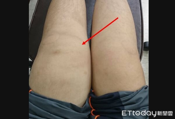 ▲傅男在2019年中旬就曾發生左膝蓋關節因病腫脹出血變形。(圖/中山醫院提供)