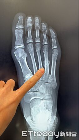 ▲陳建宏醫師提醒家長,孩子運動量過大、休息不足可能造成應力性骨折。(記者林東良翻攝,下同)