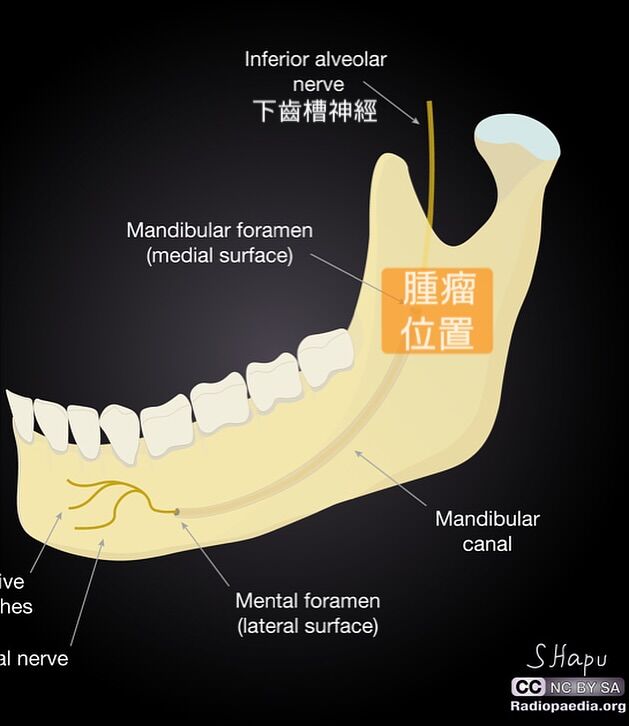 ▲一名四十多歲女子臉麻牙齦痛,竟是乳癌轉移。(圖/翻攝自耳鼻喉頭頸外科 張家豪醫師 臉書)