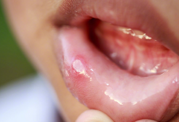 ▲李先生反覆嘴破20年。(示意圖/翻攝自微博)