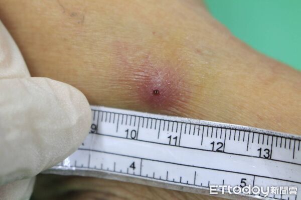 ▲▼ 活蟲 。(圖/醫師提供)