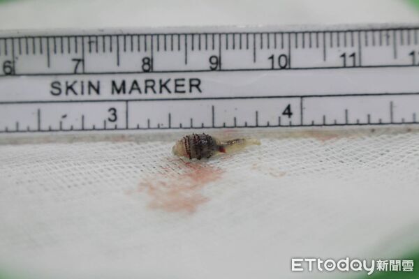 ▲▼ 活蟲 。(圖/醫師提供)