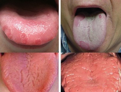 內有噁舌！舌頭7徵兆讓你健康亮紅燈