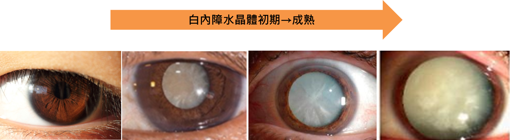 ▲▼ 。(圖/大學眼科提供)