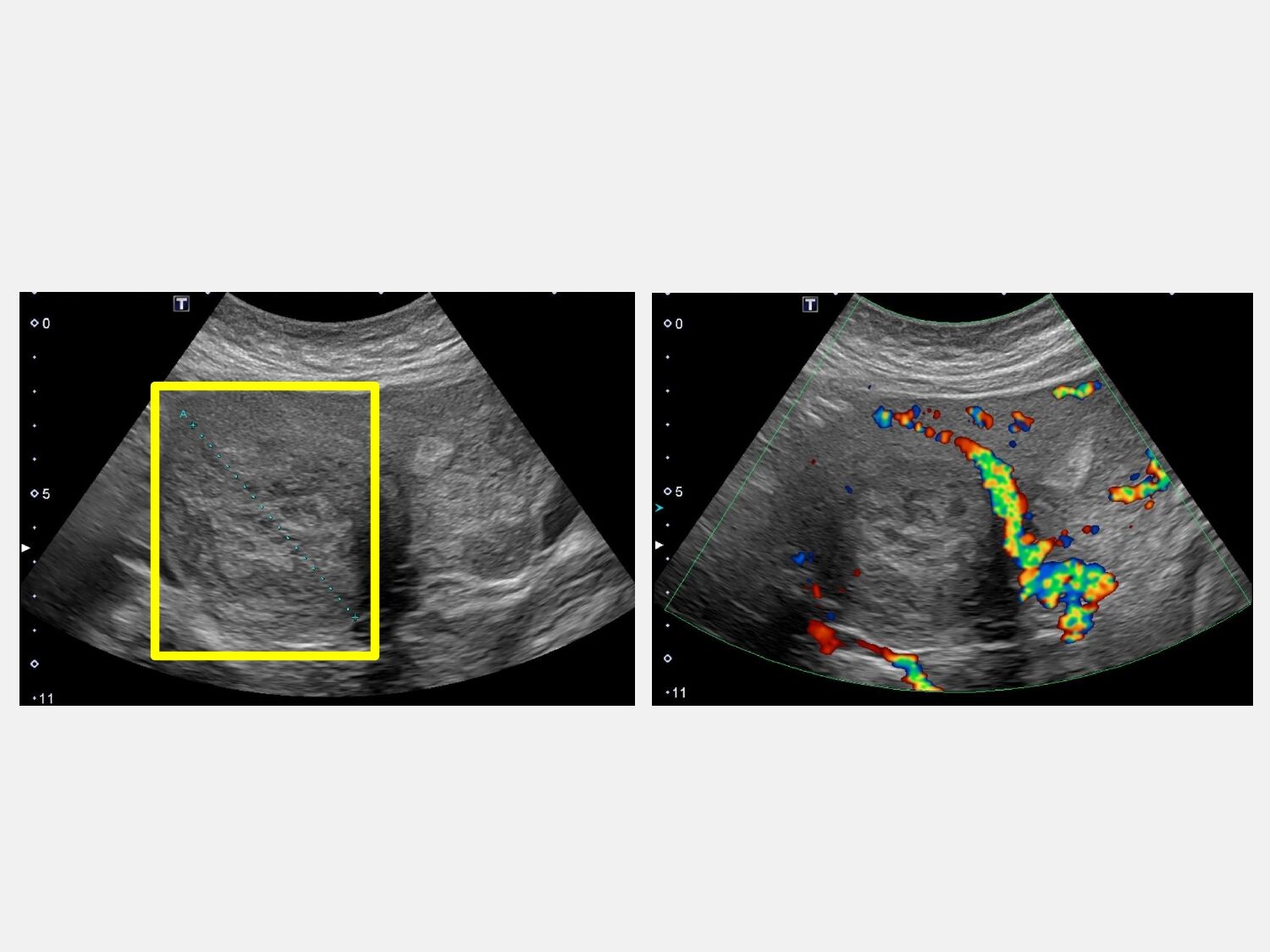 ▲▼林玉珊醫師;下腹7公分肌瘤。(圖/大里仁愛醫院)