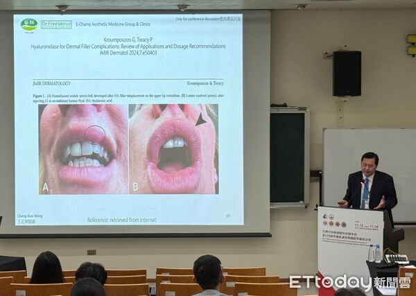 ▲王正坤醫師於台灣耳鼻喉頭頸外科醫學會進行專題演講,分享臉部微整形併發症的預防與處置。(記者林東良翻攝,下同)