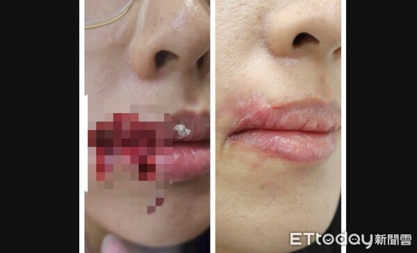 ▲與柴犬玩下一秒濺血!28歲台中女臉頰遭咬穿撕裂4cm送醫急救 。(圖/記者游瓊華翻攝)