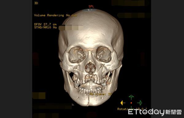 ▲建築工5米高墜落「臉骨全碎」毀容 醫刀下「不留1條疤」奇蹟重塑。(圖/亞大附醫提供)