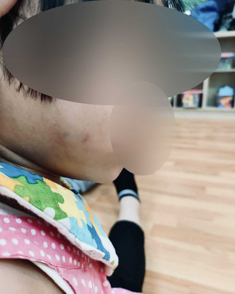 幼童因遭受老師多次大力拍打、捏臉,更有勒脖狀況,導致右臉瘀青、紅腫,布滿血絲。(圖/投訴人提供)