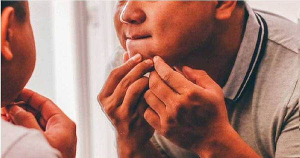 大陸一名20歲的大二學生小林(化名)近日因擠痘痘,不慎引發嚴重併發症。(示意圖/Pixabay)