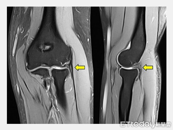 ▲陳重宇醫師表示,理學檢查及核磁共振發現女會計師肱骨外上髁炎,合併肘關節滑膜。(圖/記者游瓊華翻攝)