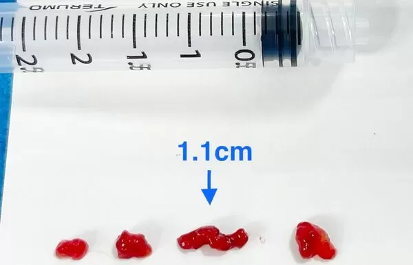 ▲心臟黏液瘤與一般缺血性血栓相比呈現晶瑩剔透狀,圖為取出四塊血栓中最大達1.1公分。(圖/聯新國際醫院提供)