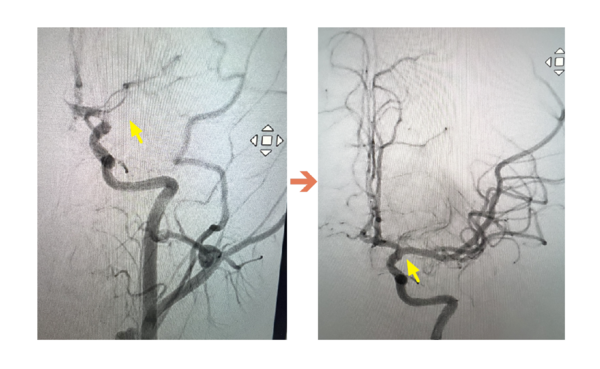 ▲ICA血管攝影,圖左箭頭處為血栓阻塞血管,圖右箭頭處為已打通血管。(圖/聯新國際醫院提供)