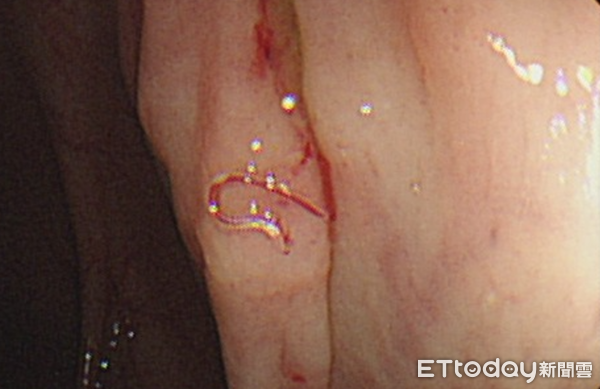 ▲▼ 鉤蟲感染 。(圖/許孟璇醫師提供)