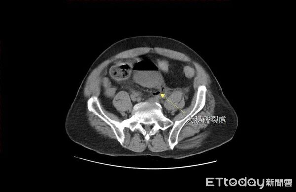 ▲苗栗65歲老翁自行灌腸,不慎造成腸破裂、糞水亂流引發腹膜炎,送醫手術後救回一命。(圖/大千綜合醫院提供)
