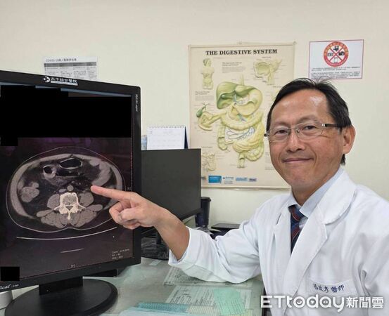 ▲苗栗65歲老翁自行灌腸,不慎造成腸破裂、糞水亂流引發腹膜炎,送醫手術後救回一命。(圖/大千綜合醫院提供)