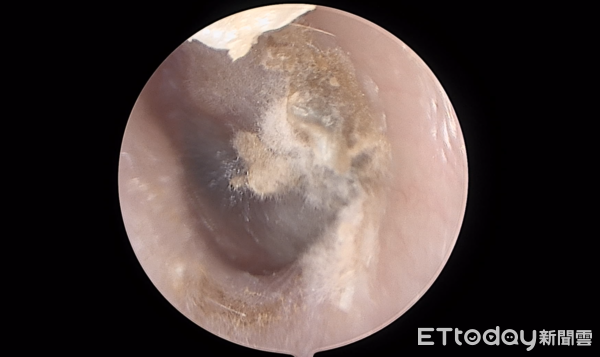 ▲他瘋越式洗頭癢爆! 「通通都是黴菌」醫一看傻了。(圖/陳亮宇醫師授權提供)