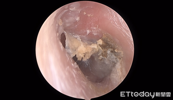 ▲他瘋越式洗頭癢爆! 「通通都是黴菌」醫一看傻了。(圖/陳亮宇醫師授權提供)