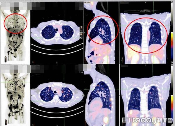 ▲▼ 免疫療法 。(圖/雙和醫院提供)