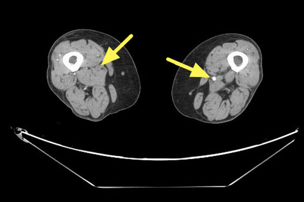 ▲腿痠腳麻竟是血管老化病變?
