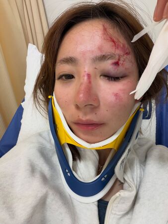 ▲▼iPhone救了她的命!日本釣魚偶像神野梓國道車禍「滿臉血」。(圖/翻攝自X)