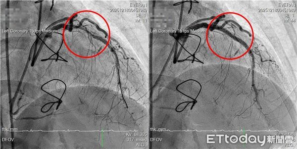 ▲IVL血管內震波技術透過低能量震波破壞深層鈣化結構,協助血管恢復彈性,降低治療風險。(圖/記者游瓊華翻攝)