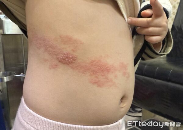 5歲妹「帶狀紅疹爬滿肚」越長越多!醫一掀衣驚:病毒沿著神經走。(圖/醫師授權提供,未經同意請勿任意翻攝)