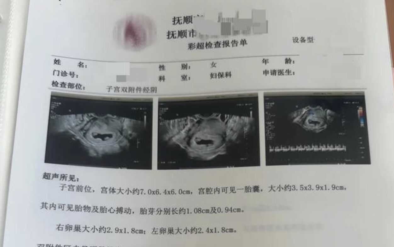 ▲遼寧王姓女子產檢時發現竟是罕見的同卵四胞胎,發生機率僅千萬分之一。(圖/翻攝極目新聞)