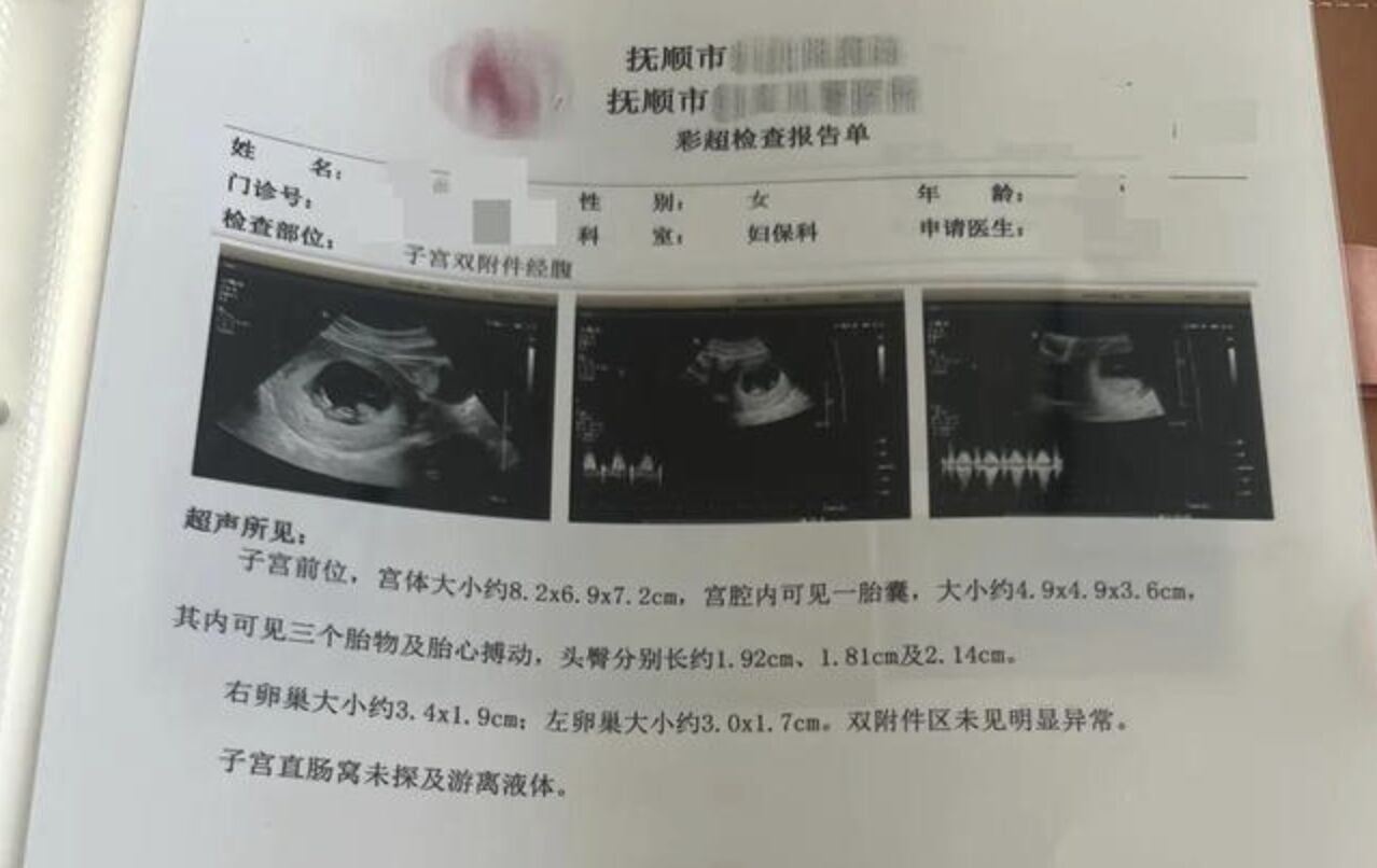 ▲遼寧王姓女子產檢時發現竟是罕見的同卵四胞胎,發生機率僅千萬分之一。(圖/翻攝極目新聞)