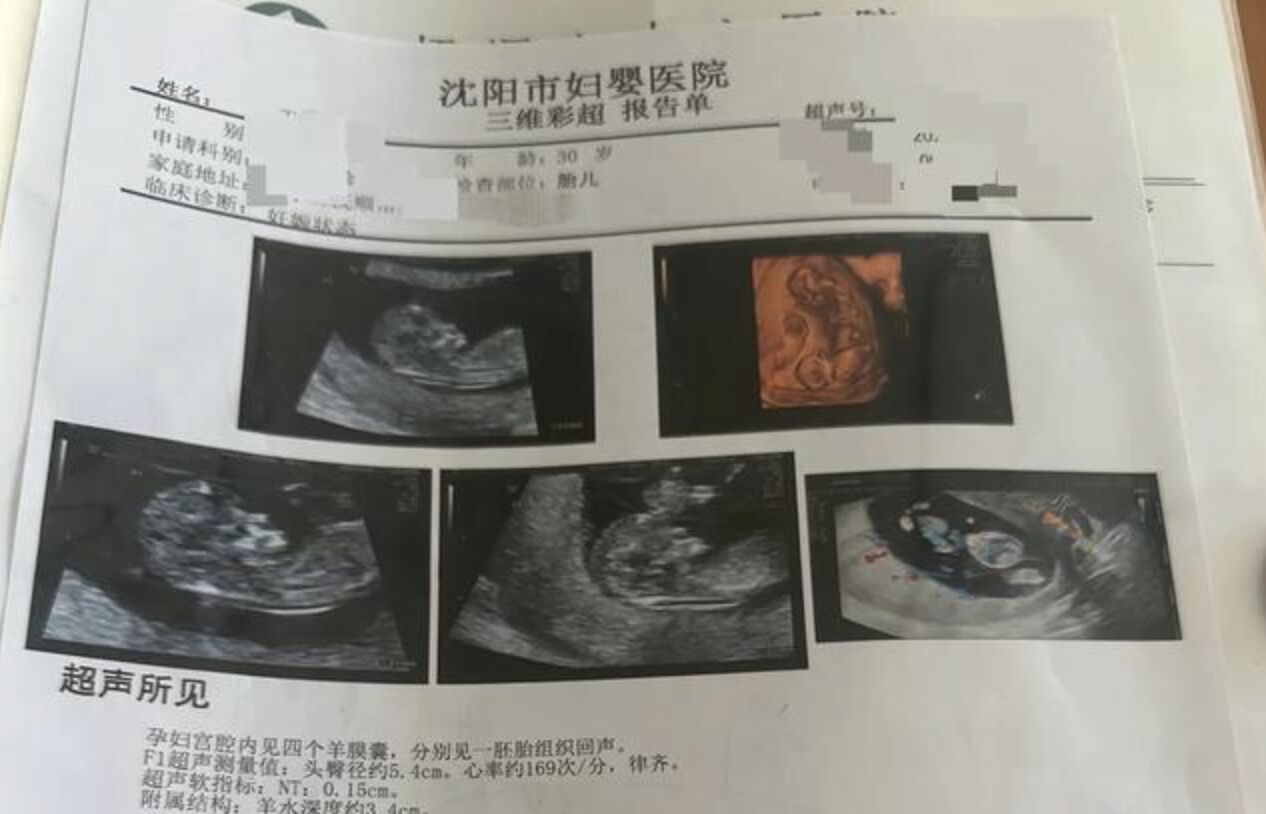 ▲遼寧王姓女子產檢時發現竟是罕見的同卵四胞胎,發生機率僅千萬分之一。(圖/翻攝極目新聞)