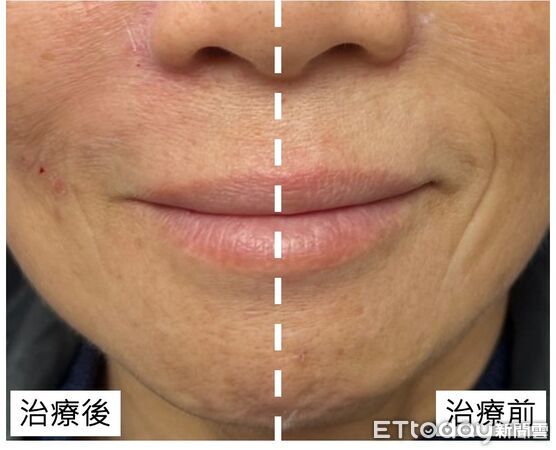 ▲醫師指出,臉部皺紋成因多元,需經專業評估後再選擇合適治療方式。(圖/記者游瓊華翻攝)