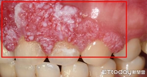 ▲口腔上顎癌,中山醫院。(圖/中山醫院提供)