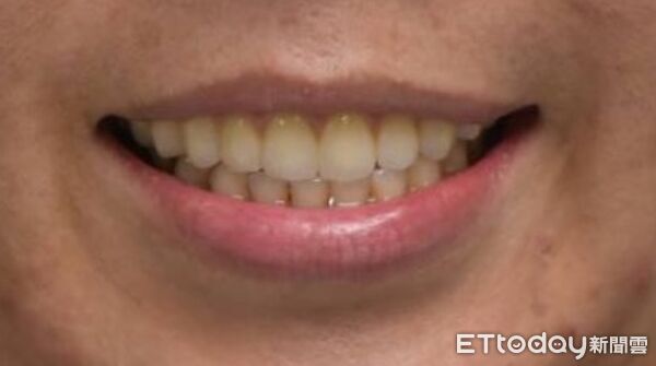 ▲口腔上顎癌,中山醫院。(圖/中山醫院提供)