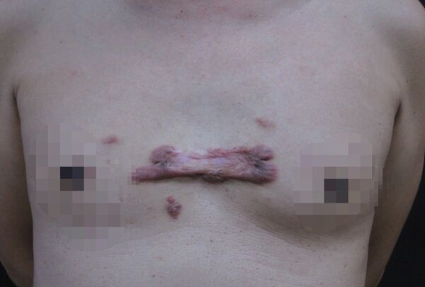 ▲▼二十多歲的男性不小心弄破胸前青春痘,變成長十餘公分、寬4、5公分俗稱「蟹足腫」的疤痕。(圖/員榮醫院提供)