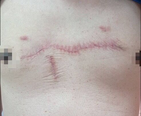 ▲▼二十多歲的男性不小心弄破胸前青春痘,變成長十餘公分、寬4、5公分俗稱「蟹足腫」的疤痕。(圖/員榮醫院提供)