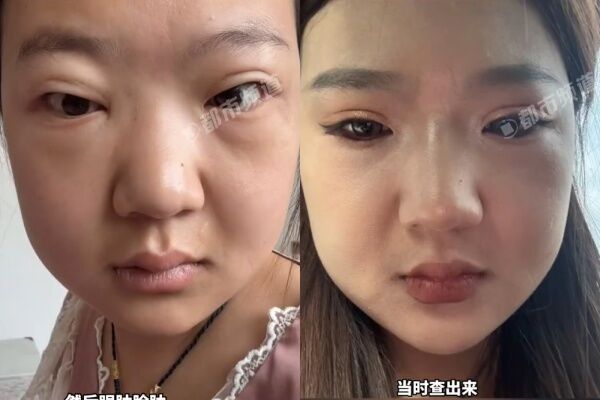 ▲▼24歲正妹增29kg以為變胖竟是「尿毒症」惹禍。(圖/翻攝自微博)