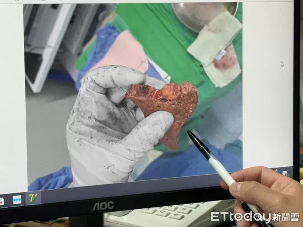 ▲台中女肝臟「6成都是油」 醫嚇到:愛吃甜食脂肪肝竟病變肝癌。(圖/李綜合醫院提供)