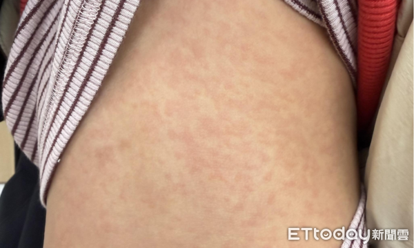▲▼好多小孩紅疹大爆發!醫警告「1類衣服」恐是皮膚災難。(圖/顏俊宇醫師授權提供,未經同意請勿任意翻攝)