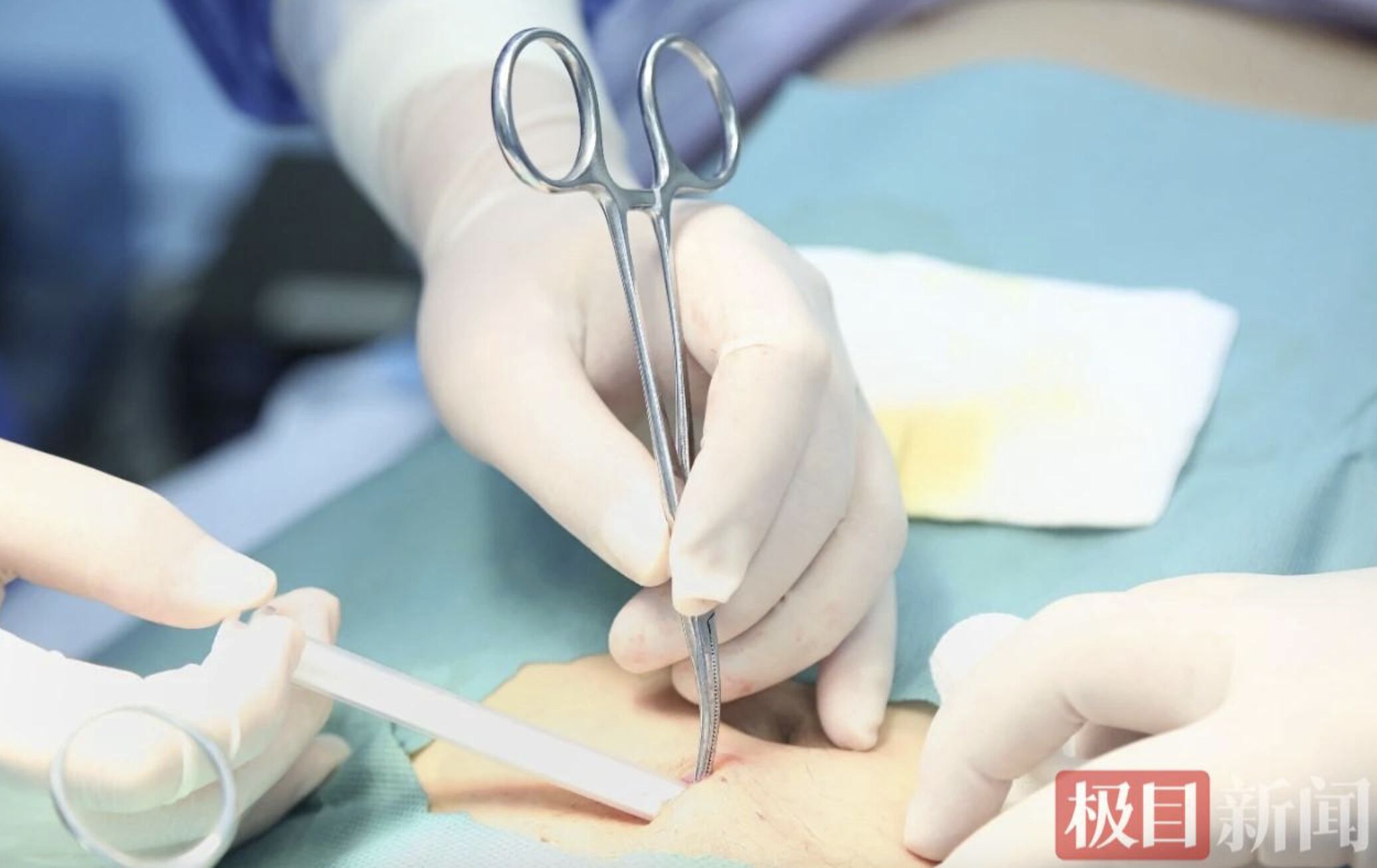 ▲醫院替患者植入戒酒晶片。(圖/翻攝極目新聞)