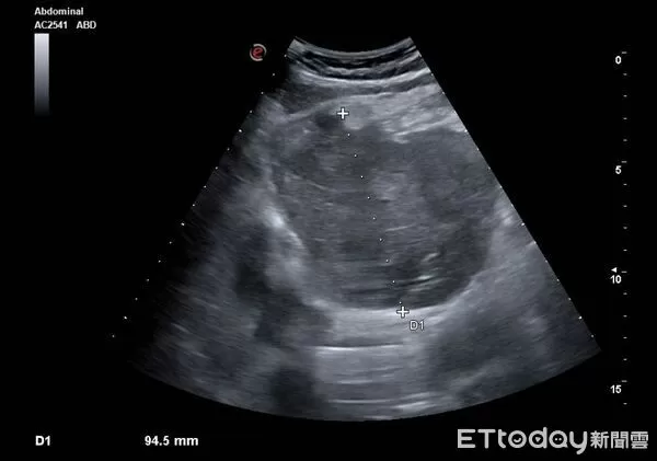 ▲▼「黃便上面蓋點血!」30歲男當痔瘡拖4年 醫嘆:不到1年就走了。(圖/陳保中醫師授權提供,未經同意請勿任意翻攝)