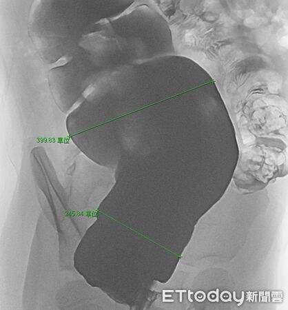 出生沒順暢過!4歲妹「從小靠灌腸」才大便 醫揪病因:常被誤認。(圖/新營醫院提供)