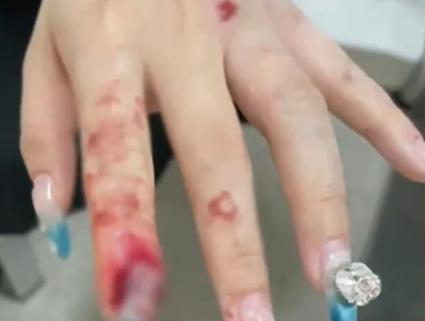 ▲王小姐的真甲因摔倒掀起。(圖/翻攝自微博)