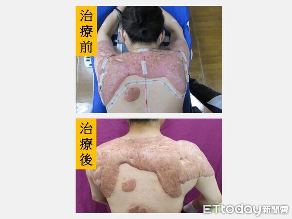 ▲50歲蔡姓女子因蟹足腫困擾30多年,經跨科治療後病灶明顯改善。(圖/記者游瓊華翻攝)