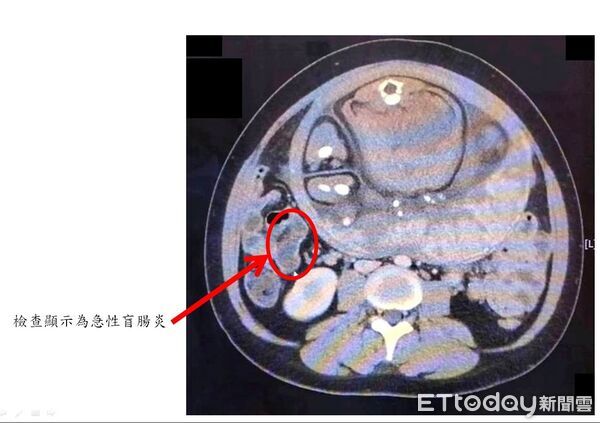 ▲懷孕39週的孕婦急性盲腸炎送急診,大千醫療團體緊急開刀,一次完成男嬰生產和切除盲腸手術。(圖/大千綜合醫院提供)