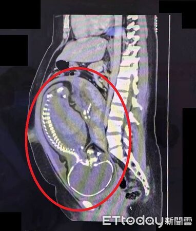 ▲懷孕39週的孕婦急性盲腸炎送急診,大千醫療團體緊急開刀,一次完成男嬰生產和切除盲腸手術。(圖/大千綜合醫院提供)