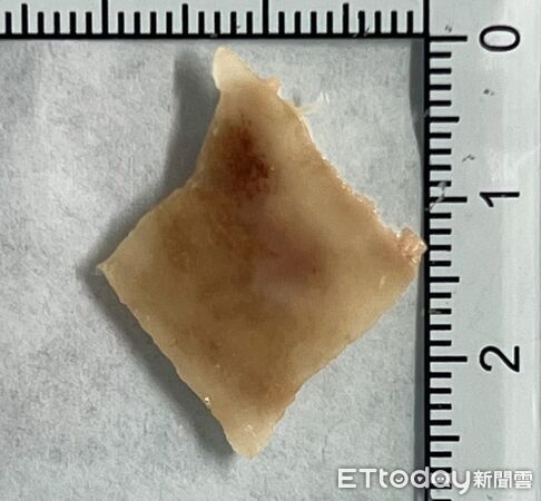 ▲他喉嚨痛…醫夾出「2.5cm菱形骨」! 誤吞5類異物恐穿孔。(圖/李柏賢醫師授權提供,未經同意請勿任意翻攝)