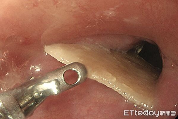 ▲他喉嚨痛…醫夾出「2.5cm菱形骨」! 誤吞5類異物恐穿孔。(圖/李柏賢醫師授權提供)