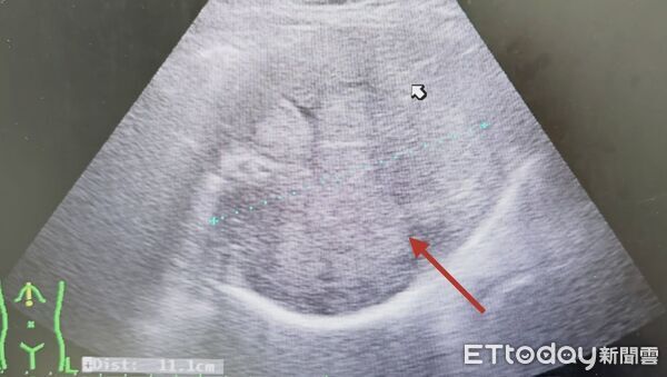 ▲以為切完就沒事!他7年沒回診 醫一照驚見「無數腫瘤佔滿肝臟」。(圖/張靖醫師授權提供,未經同意請勿任意翻攝)