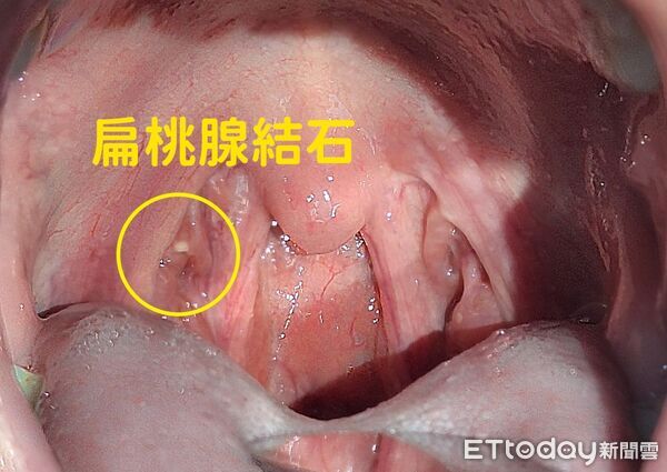 ▲▼刷牙也沒用!喉嚨藏「黃白小顆粒」臭翻 醫4招斷絕:別用手摳。(圖/張嘉峻醫師授權提供,未經同意請勿任意翻攝)