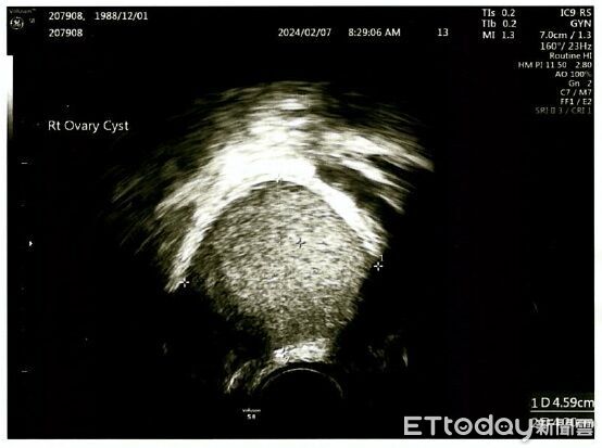 ▲醫師以單孔微創腹腔鏡手術切除卵巢畸胎瘤,保留患者生育功能。(圖/記者游瓊華翻攝)